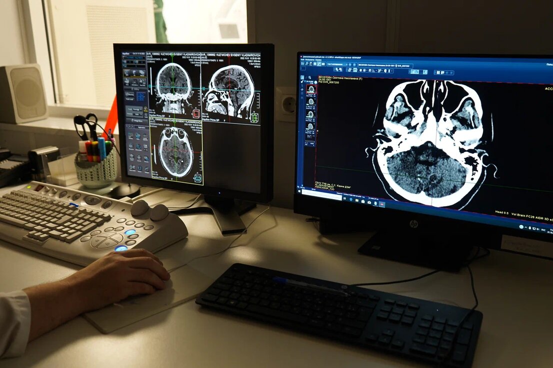 Медспециалисты рассказали о современных способах борьбы с инсультом
